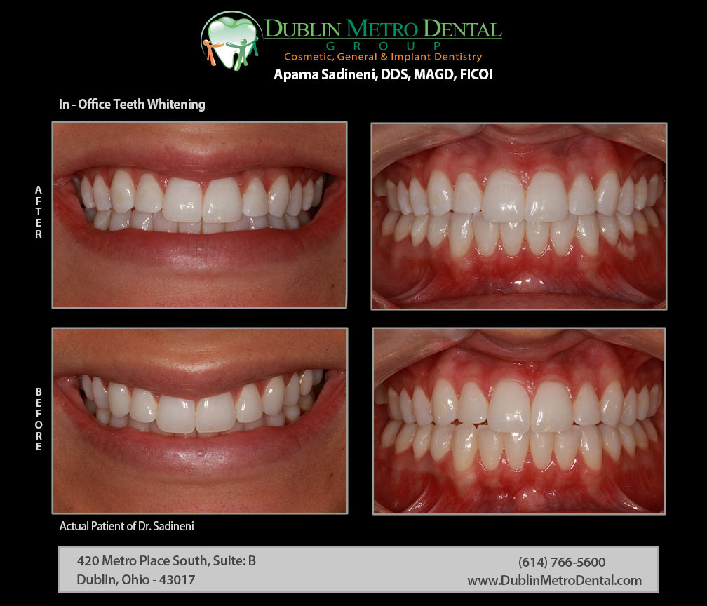 Cosmetic Dentistry, Dental Implants, Teeth Whitening, Before and After
