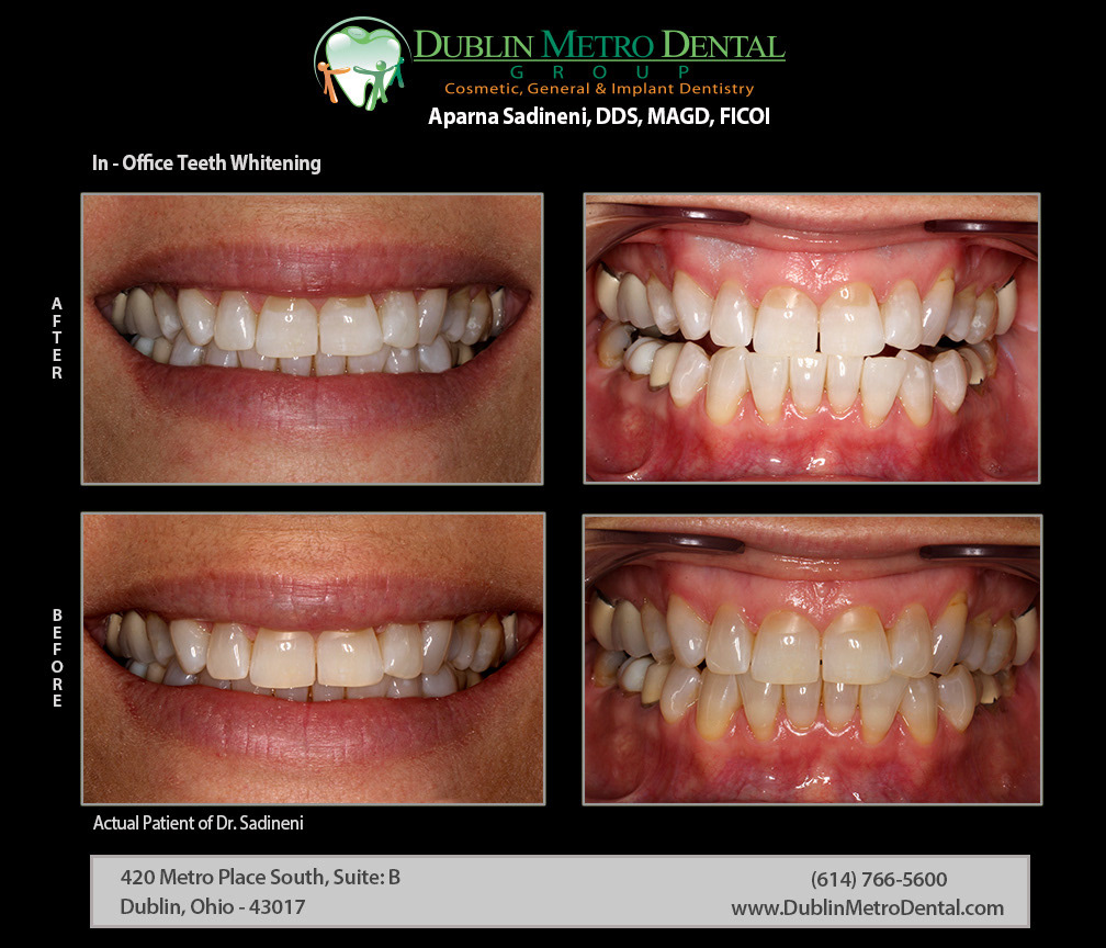 Cosmetic Dentistry, Dental Implants, Teeth Whitening, Before and After