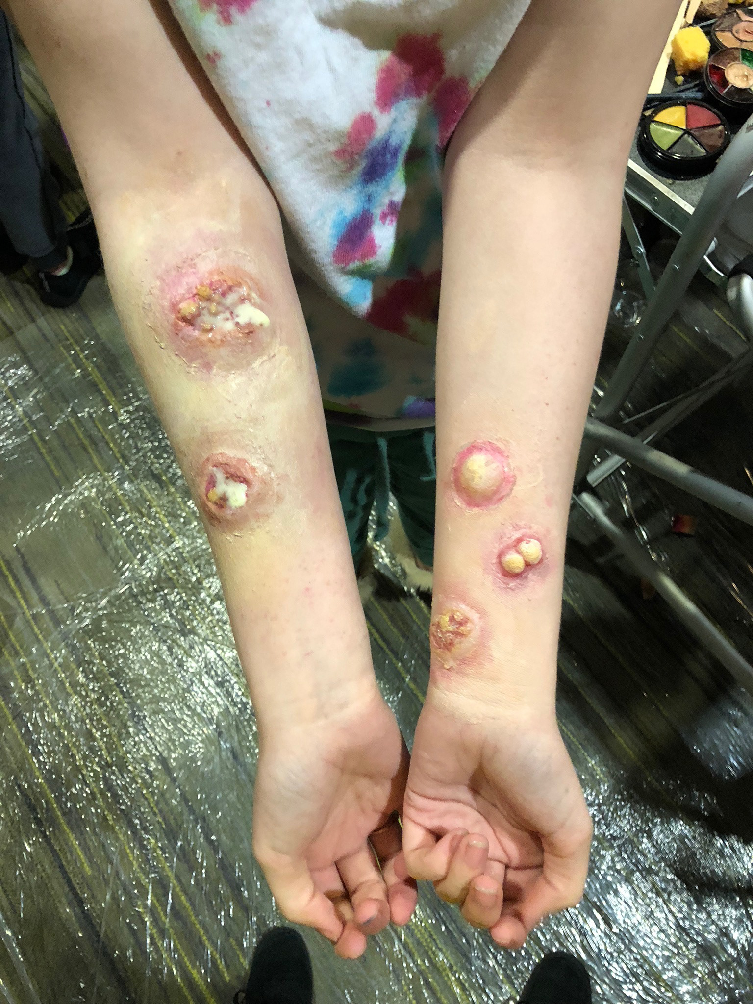 April 2018— Arm Infection