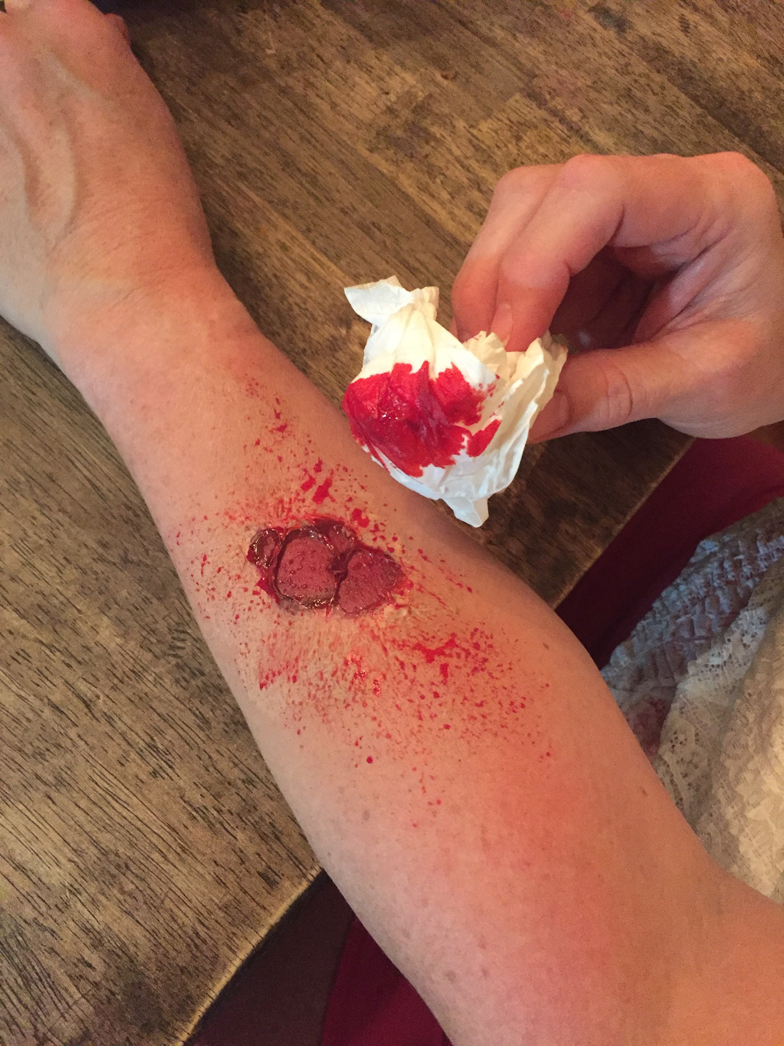 May 2017— Bursted Blister