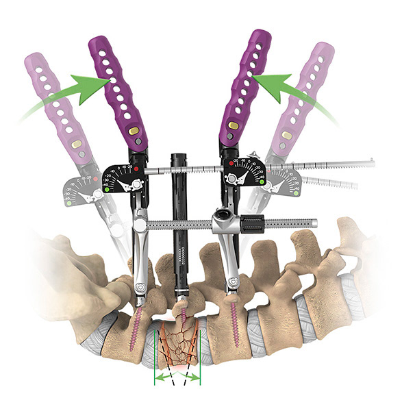 Medical illustration of orthopedic repair of burst fracture of the lumbar spine.