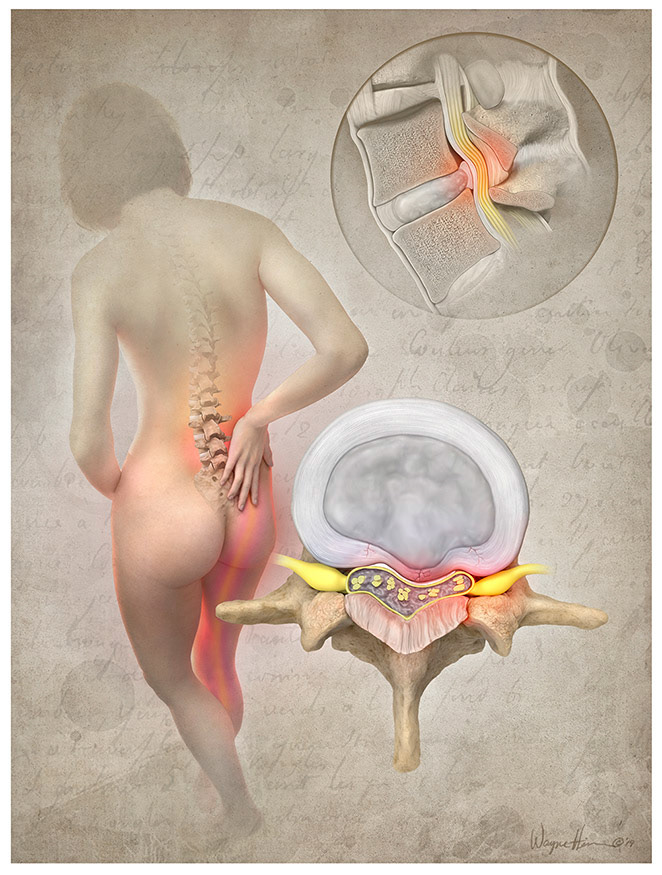 Lumbar Back Pain