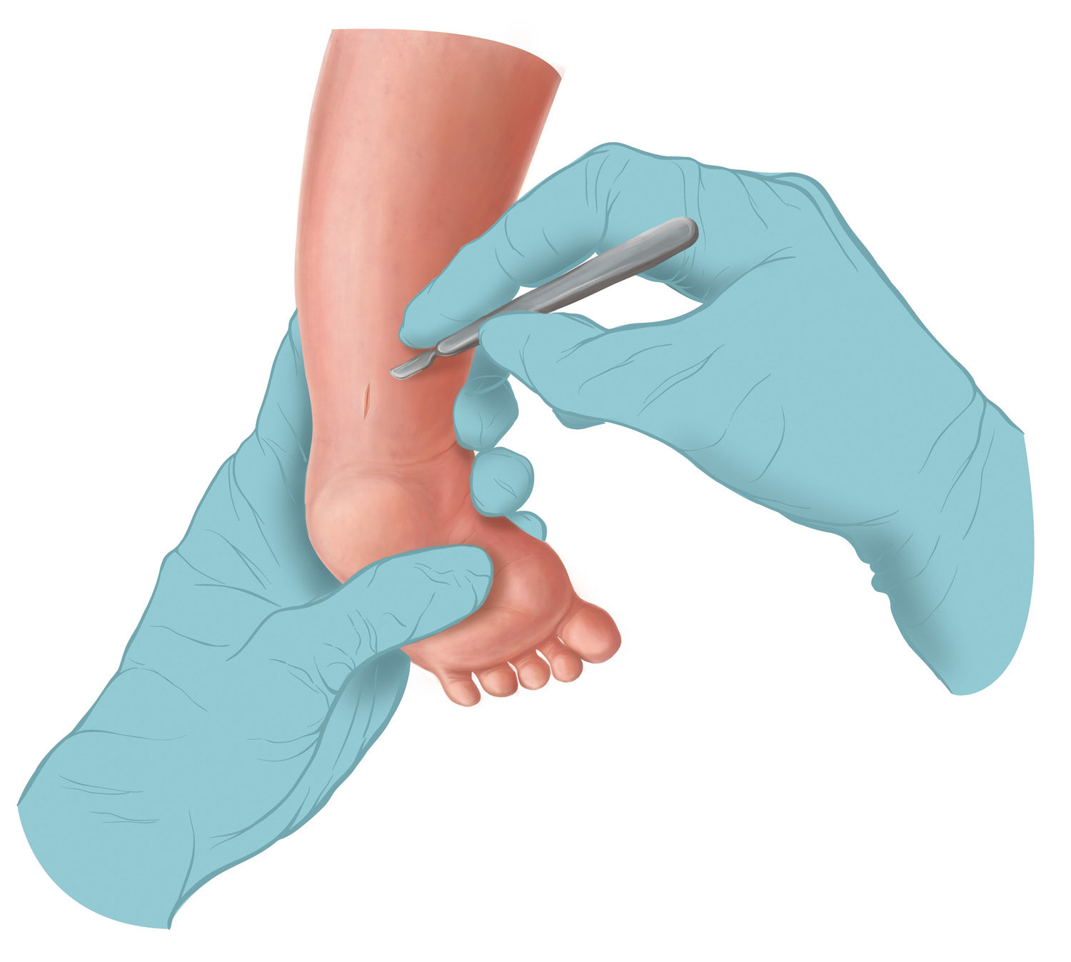 Emma Scheltema Illustration - Clubfoot Tenotomy for Starship Child Health