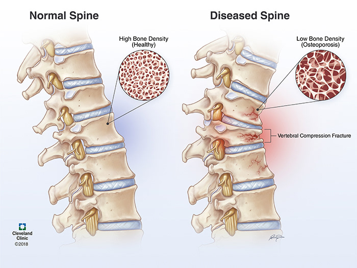 Brandon Stelter - Vertebral Compression Fractures