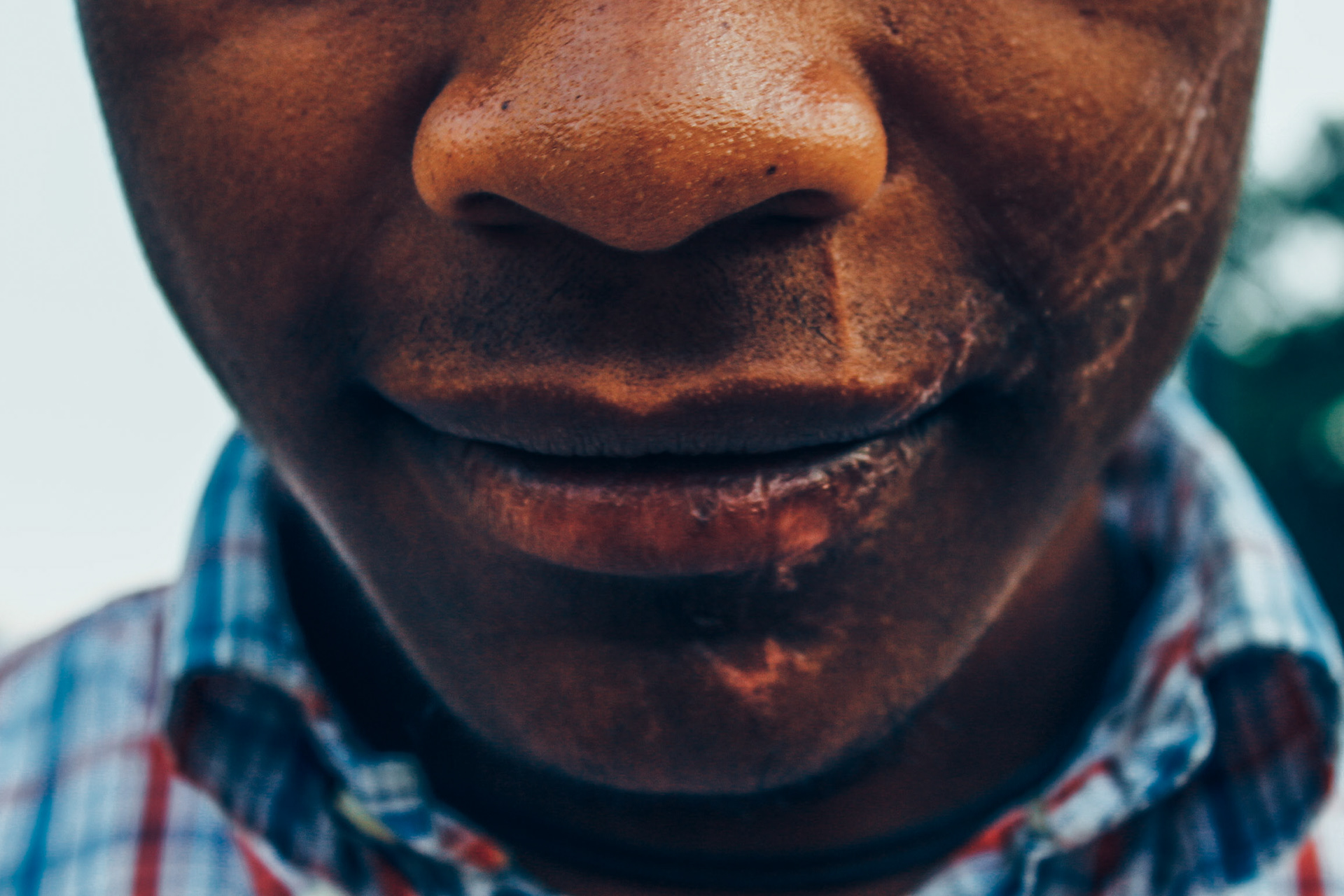 A 17 years old protester shows the scars of a tear gas canister that impacted in his face during a protest. Caracas 2014