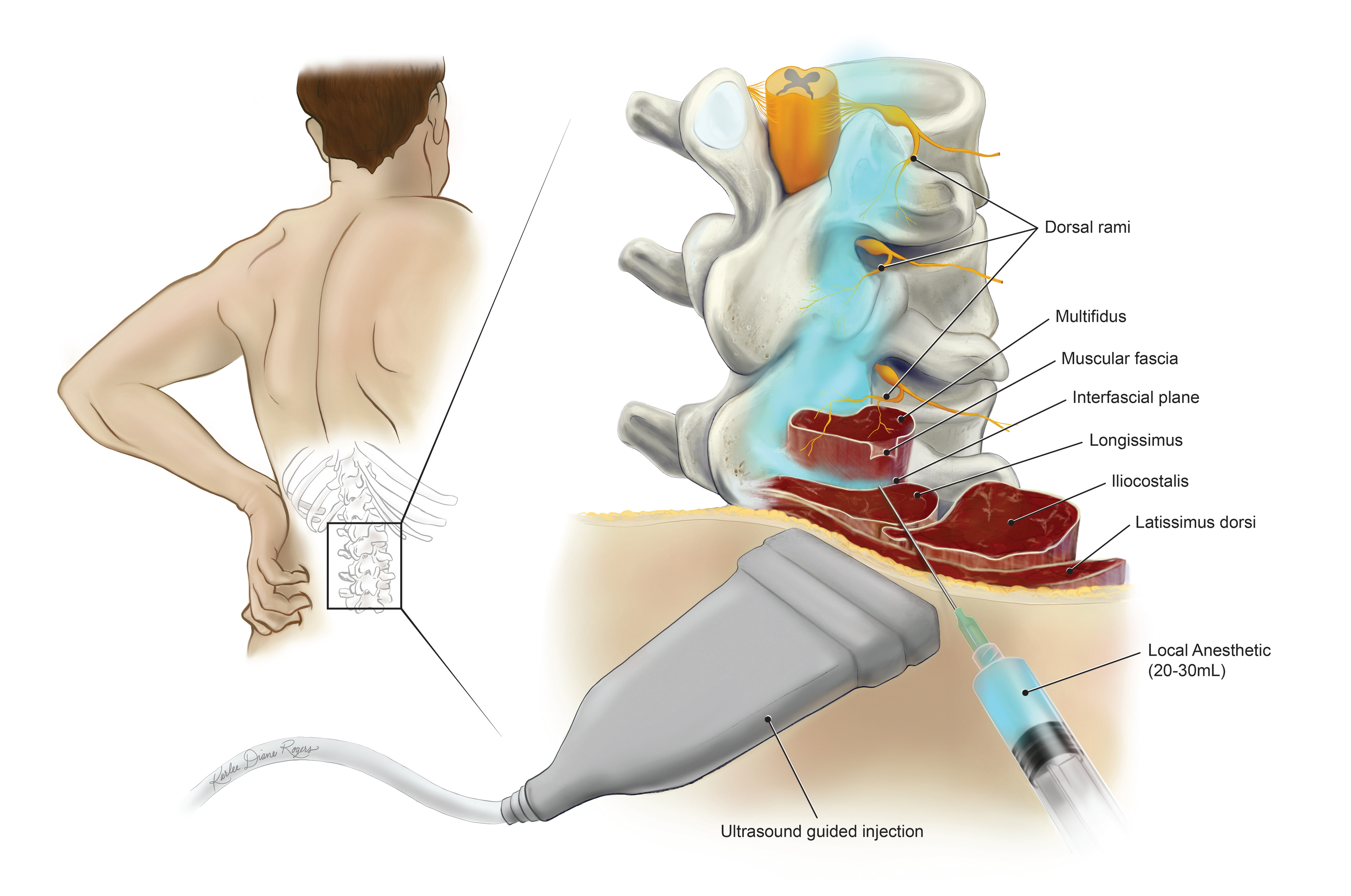 Thoraco-lumbar Inter-facial Plane block for a journal article on post-surgical pain management