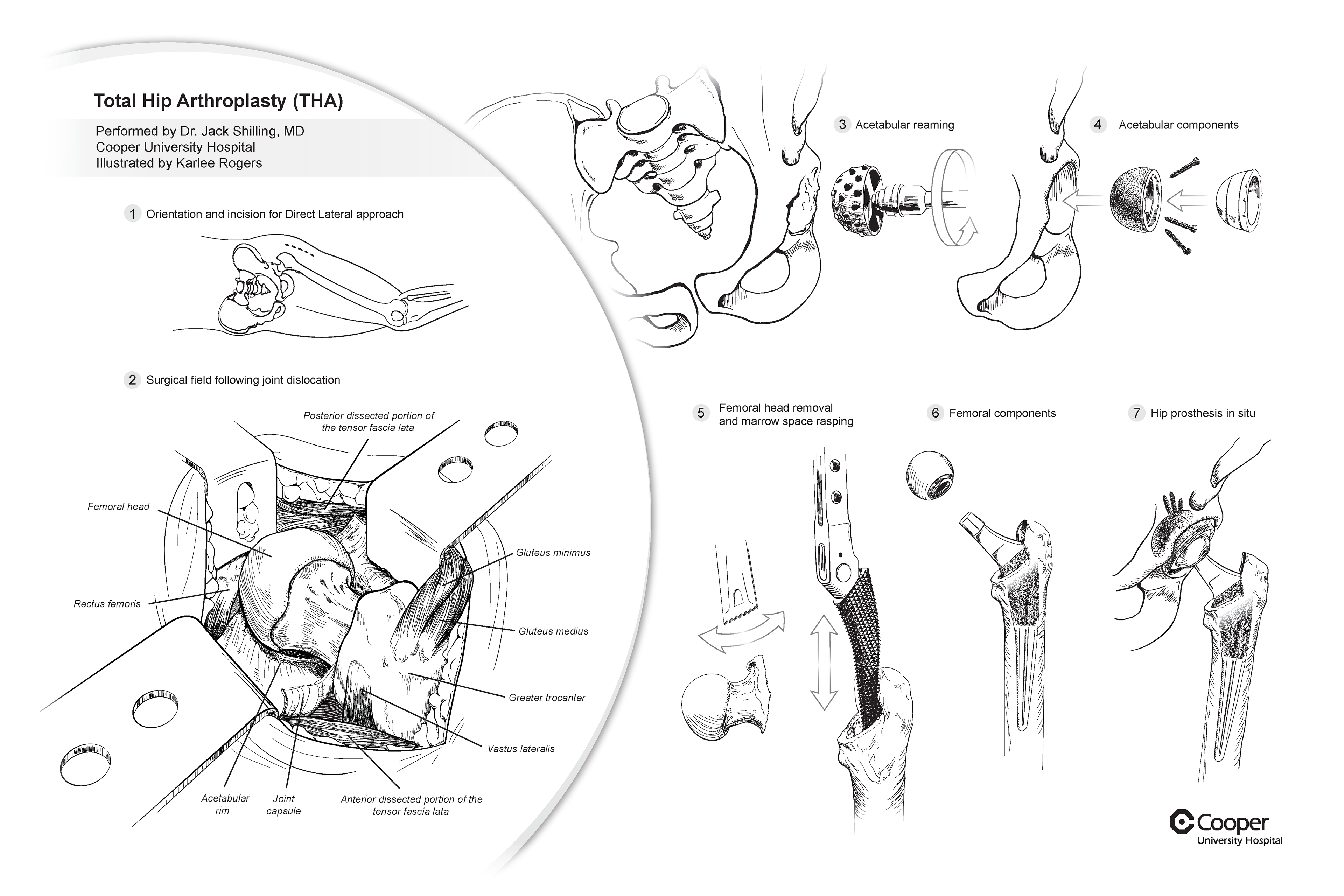 Surgical plate from in-person observation of THA surgery