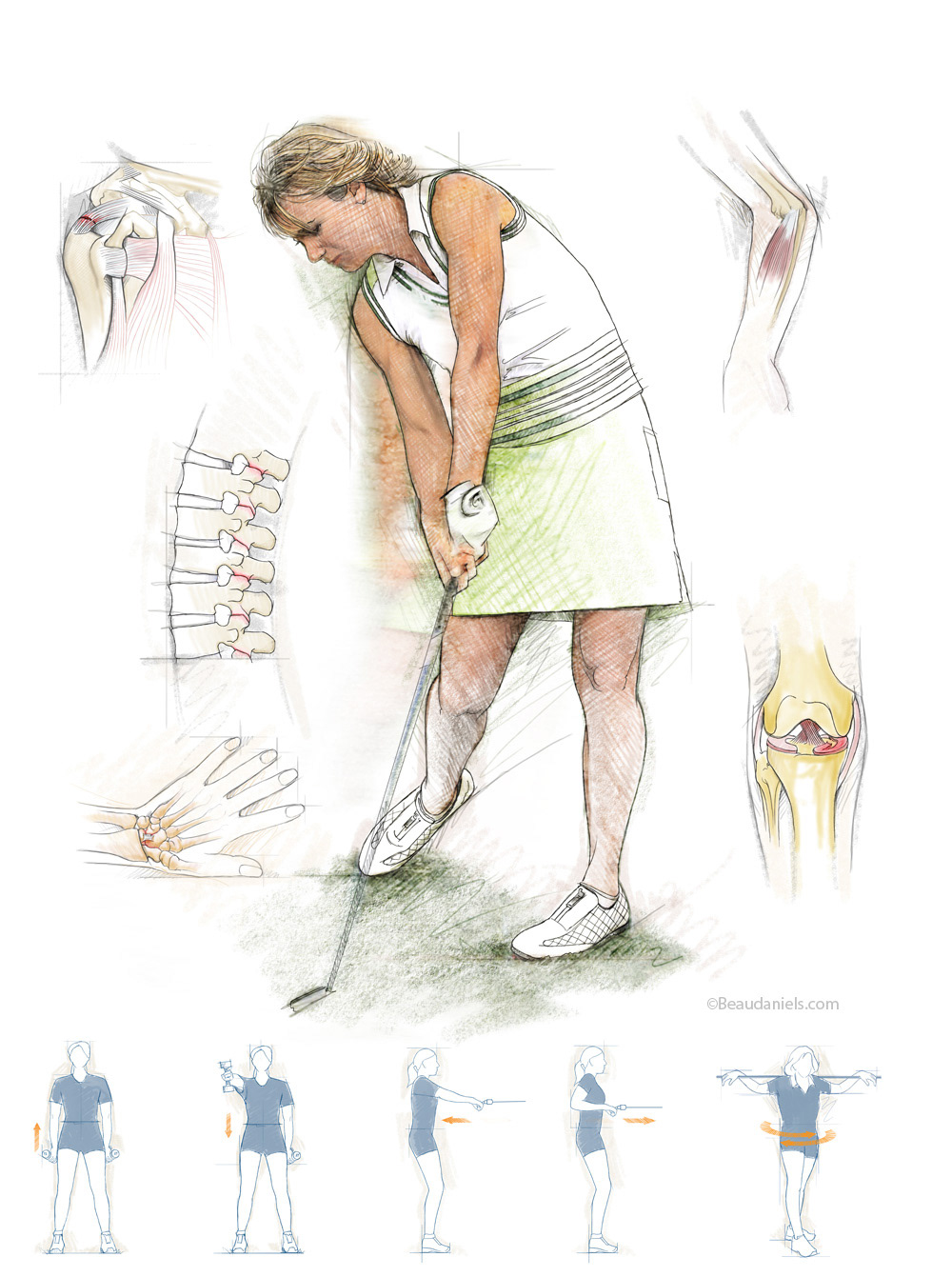 Golf injury.